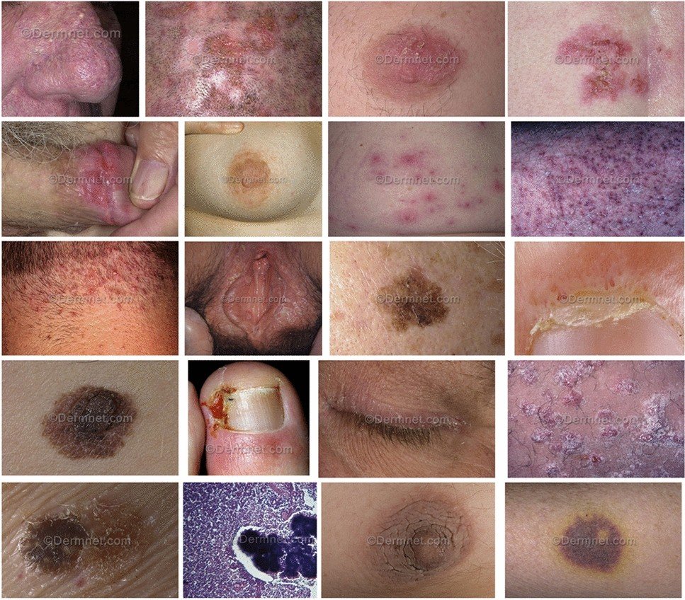 Dermatology Disorder